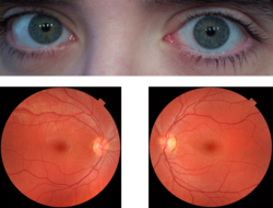 Deux yeux et deux fonds d'œil